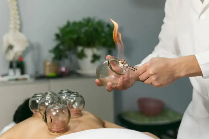 Therapist heating a cupping jar with fire before treatment